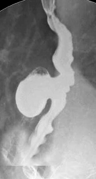 Resection Of Mid And Distal Esophageal Diverticulum Springerlink