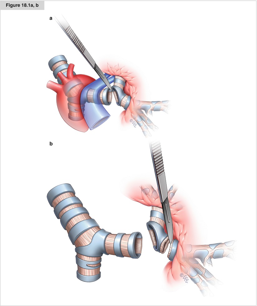 Bronchial Sleeve Resection SpringerLink