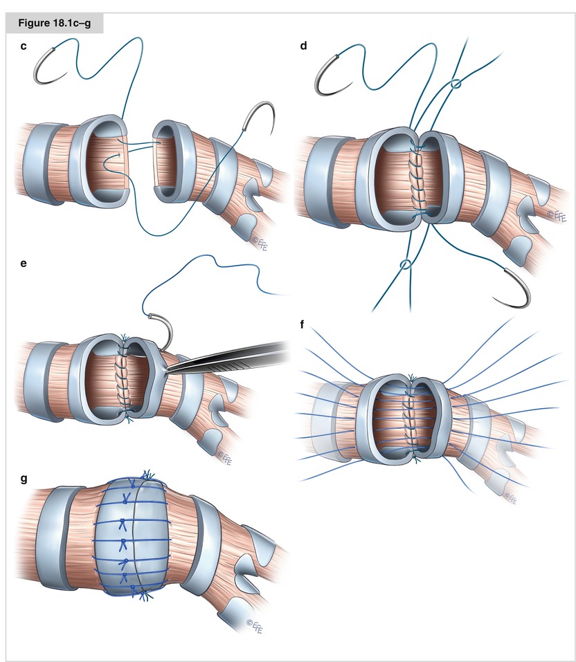 Bronchial Sleeve Resection SpringerLink