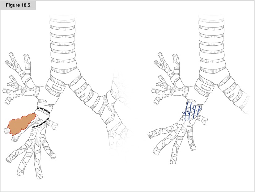 Bronchial Sleeve Resection SpringerLink