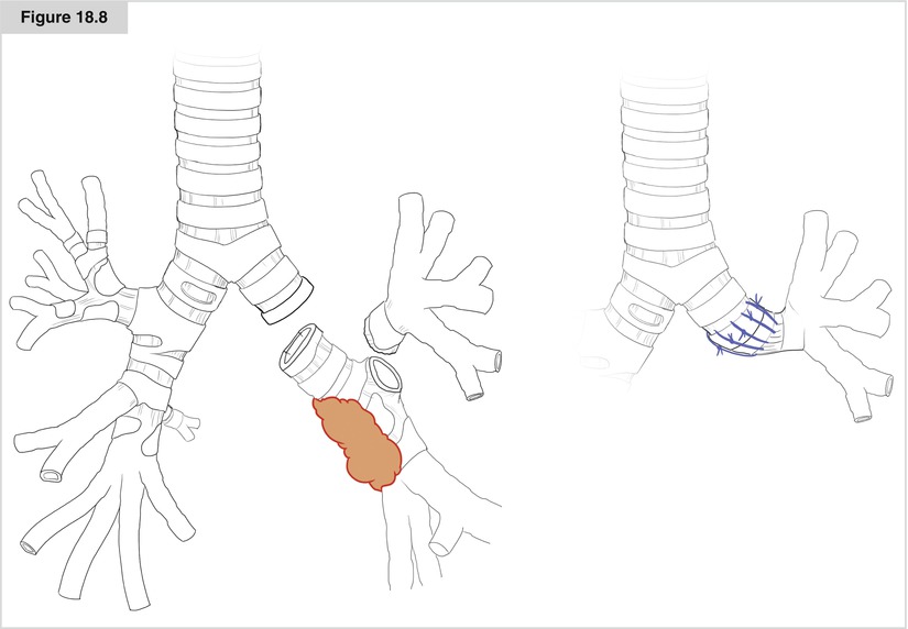 Bronchial Sleeve Resection SpringerLink