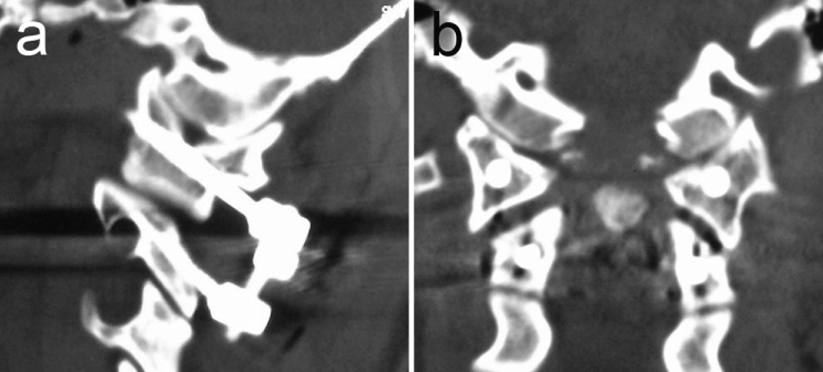 Specific Reconstruction Techniques Of Upper Cervical Spine