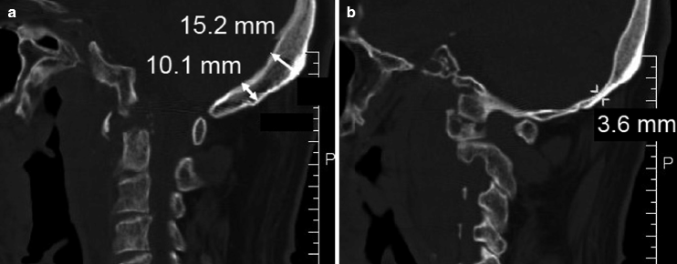 Specific Reconstruction Techniques Of Upper Cervical Spine
