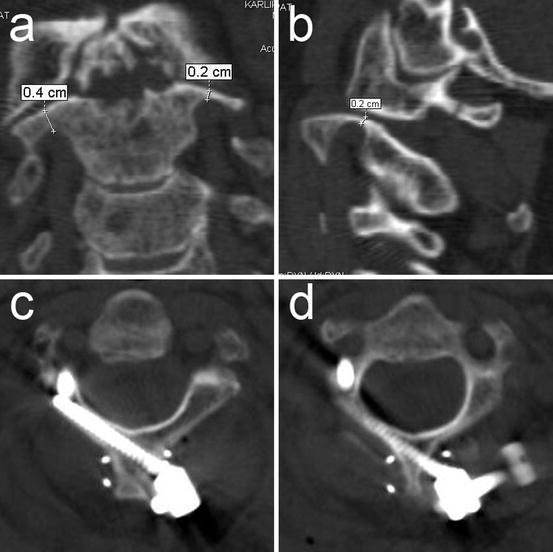 Specific Reconstruction Techniques Of Upper Cervical Spine