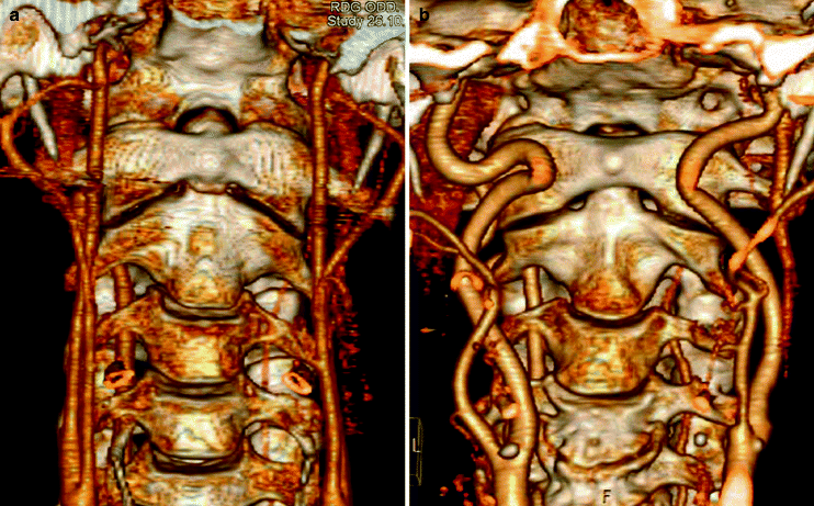 Specific Reconstruction Techniques Of Upper Cervical Spine
