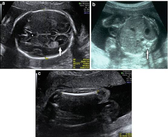 Trimester ultrasound second Pregnancy Ultrasounds