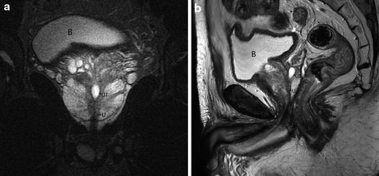 prostate cyst mri)