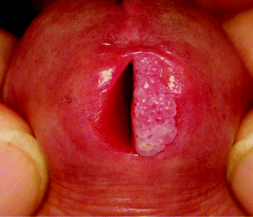 hpv lesion urethra)