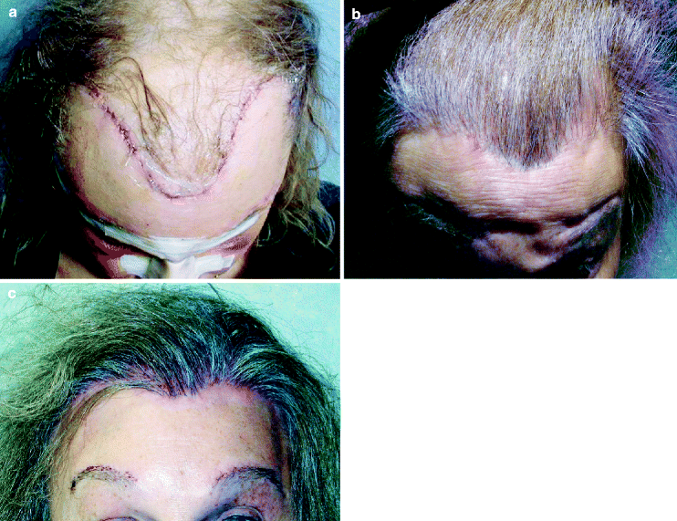 Hair Transplantation Springerlink