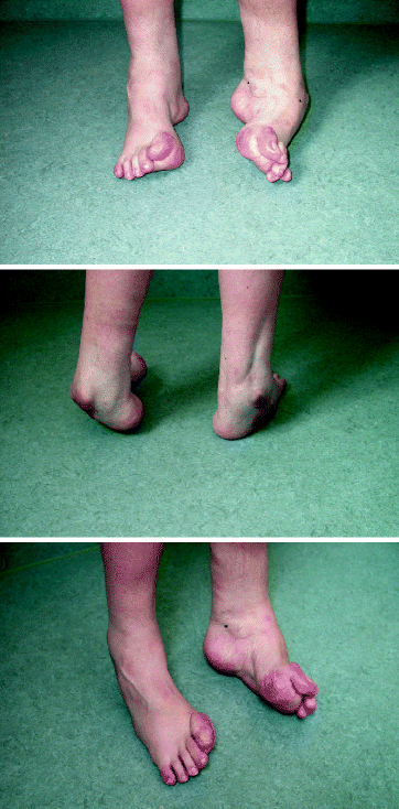The Current State Of Treatment For Clubfoot In Europe Springerlink The Current State Of Treatment For Clubfoot In Europe Springerlink