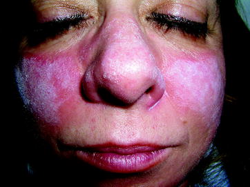 Types Of Chemical Peels Advantagesdisadvantages An - 