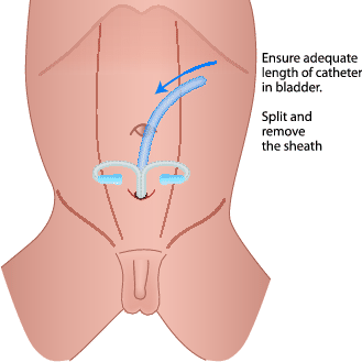 G2 Urethral and Suprapubic Catheterisation | SpringerLink G2 Urethral and Suprapubic Catheterisation | SpringerLink