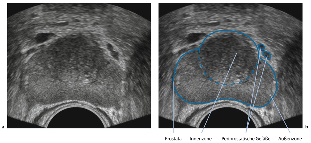 Chronische prostatitis medikamente. Klinische Studien zur Infections, Urinary Tract