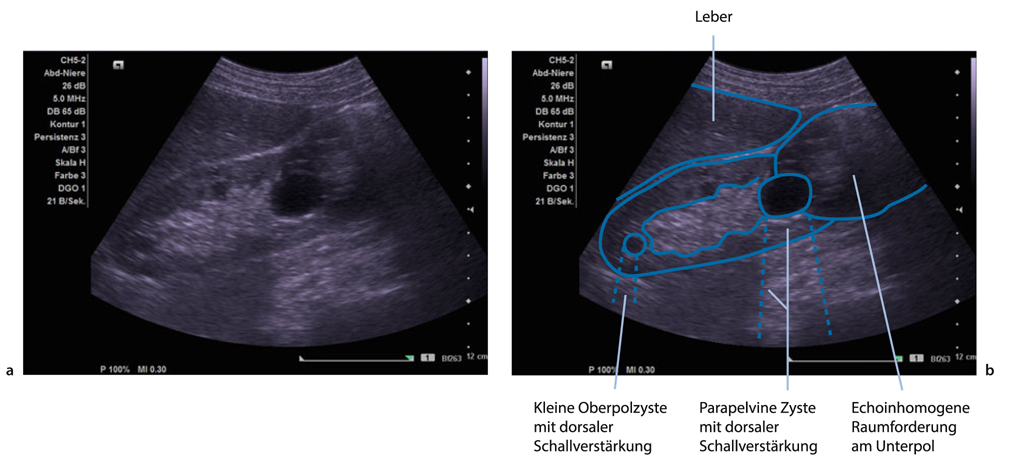 Gutartige Veranderungen Der Niere Springerlink