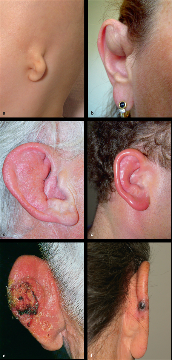Klinik des äußeren Ohres | SpringerLink