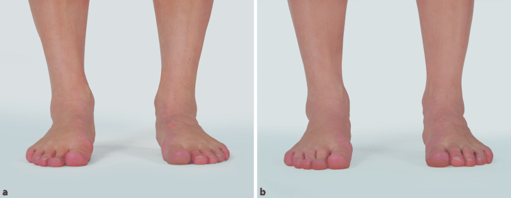 Beinachsen und Abrollen des Fußes | SpringerLink