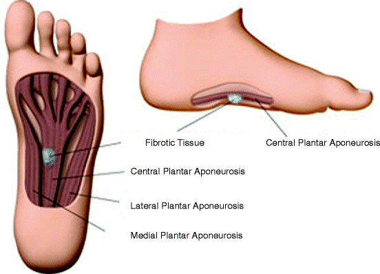 plantar fibroma pain