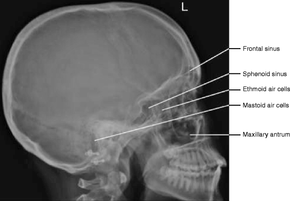 Paranasal Sinuses Springerlink Paranasal Sinuses Springerlink