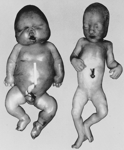 Erythroblastosis Fetalis And Hydrops Fetalis Springerlink