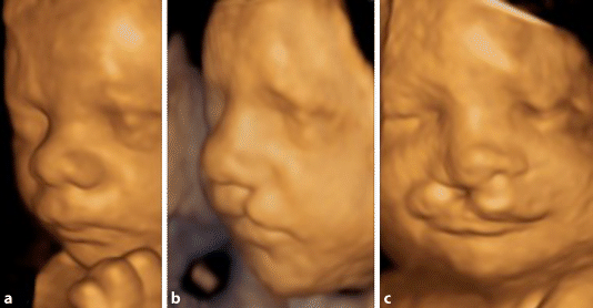 Dreidimensionale Ultraschalldiagnostik in der Geburtshilfe | SpringerLink