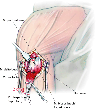 Lbs tenodese