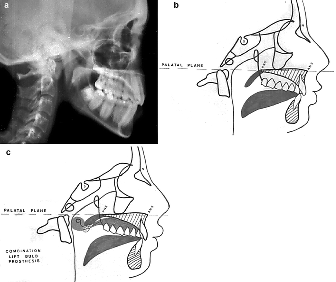Palatal Lift Prosthesis for the Treatment of Velopharyngeal ...