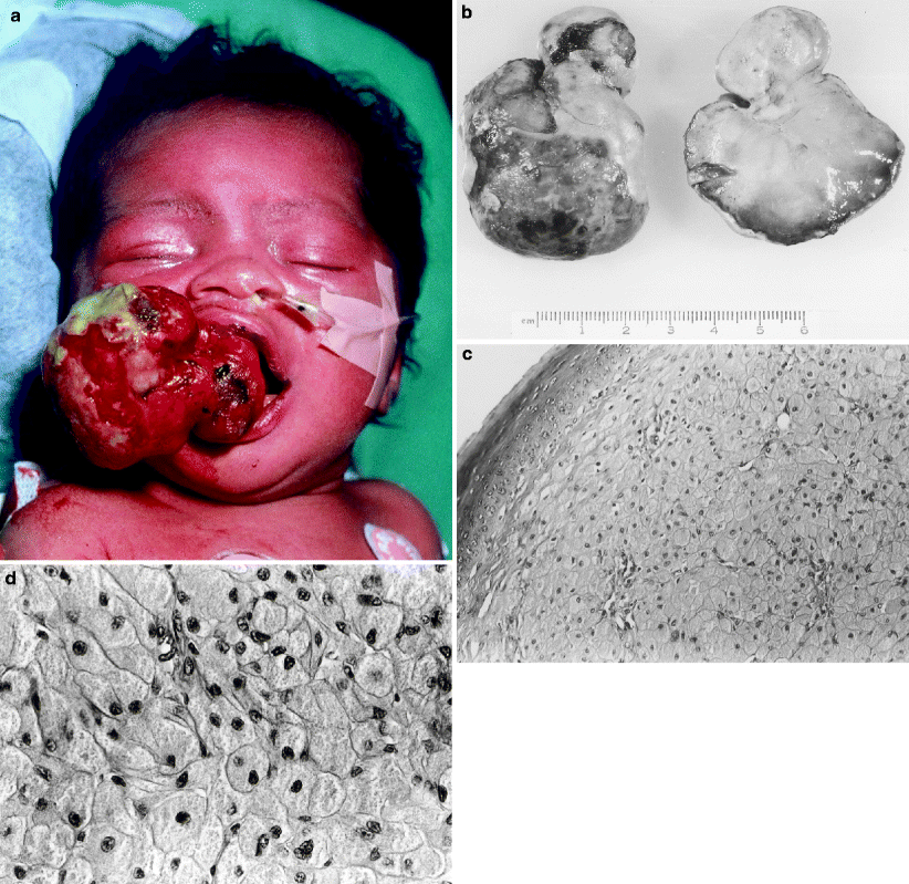 Soft Tissue Tumors Springerlink - 