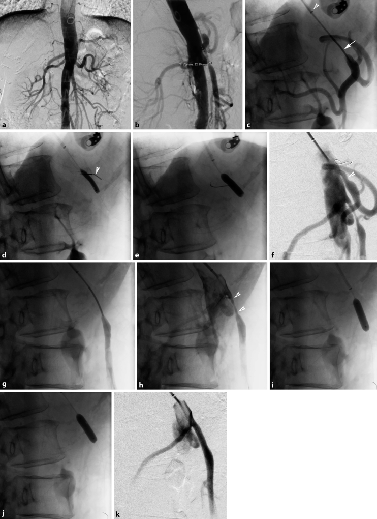 Arterielle Interventio...
