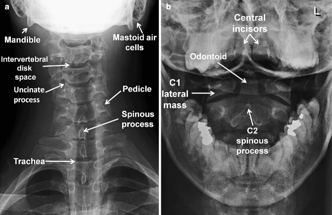 Radiologic Imaging of the Spine | SpringerLink