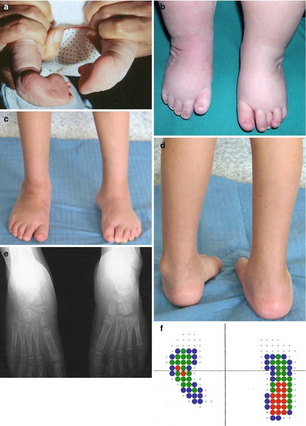 Management Of Clubfoot Springerlink