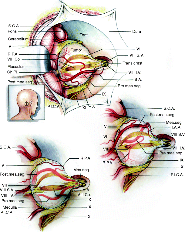 Microsurgical Anatomy Of The Cerebellopontine Angle By The Retrosigmoid Approach Springerlink 8049