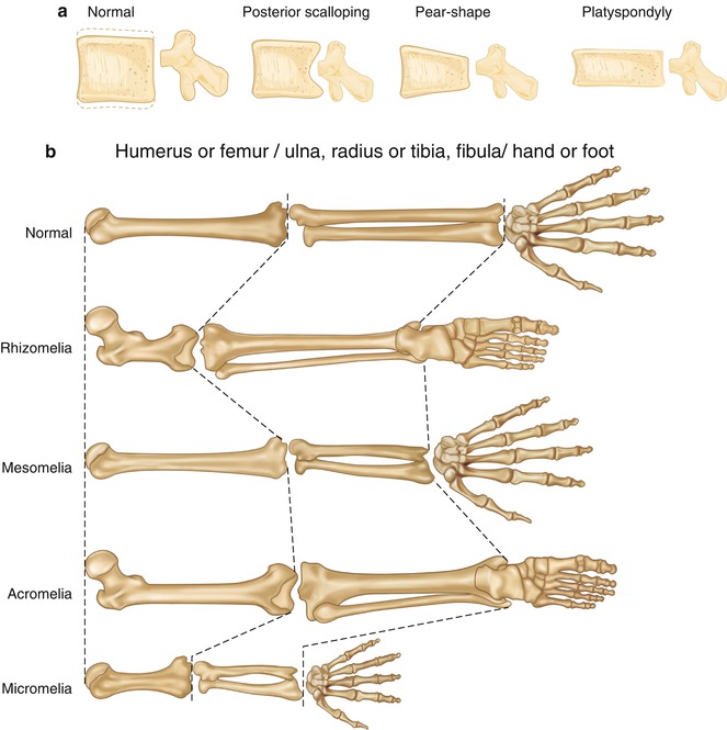 Genetic Skeletal Disorders | SpringerLink