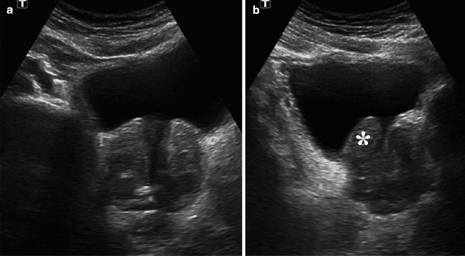benign prostatic hyperplasia ultrasound
