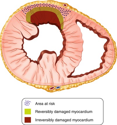 Acute Myocardial Infarction | SpringerLink