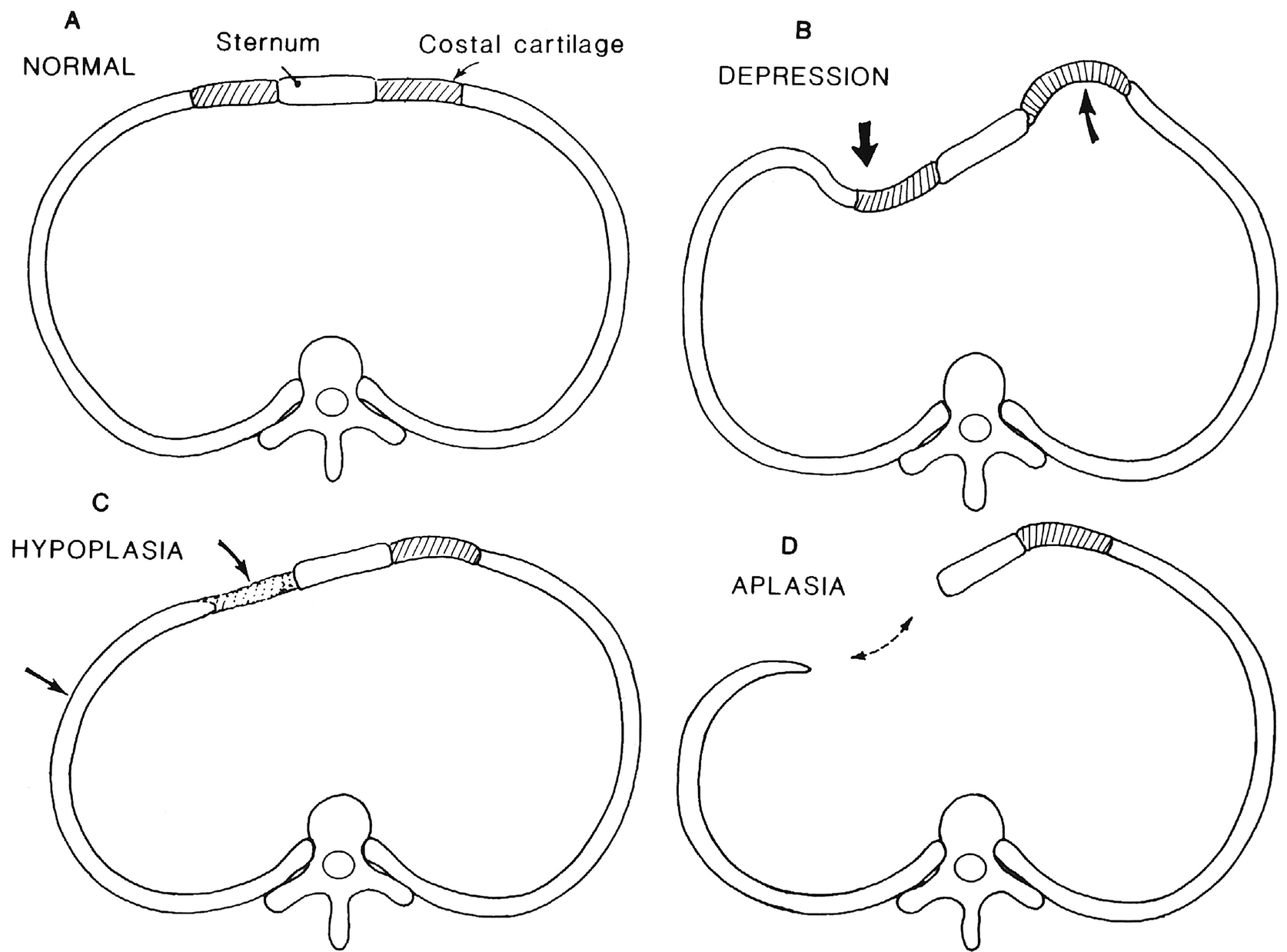 Рахитическая грудная клетка рисунок схематично
