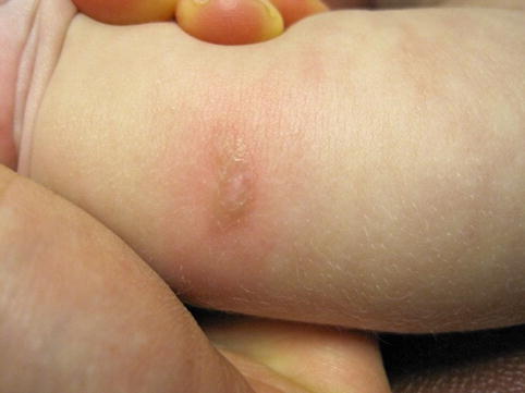 pediatric mastocytosis springerlink