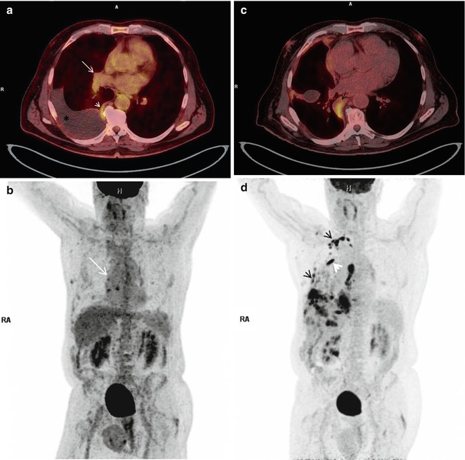 Functional Imaging Of Malignant Pleural Mesothelioma And - 