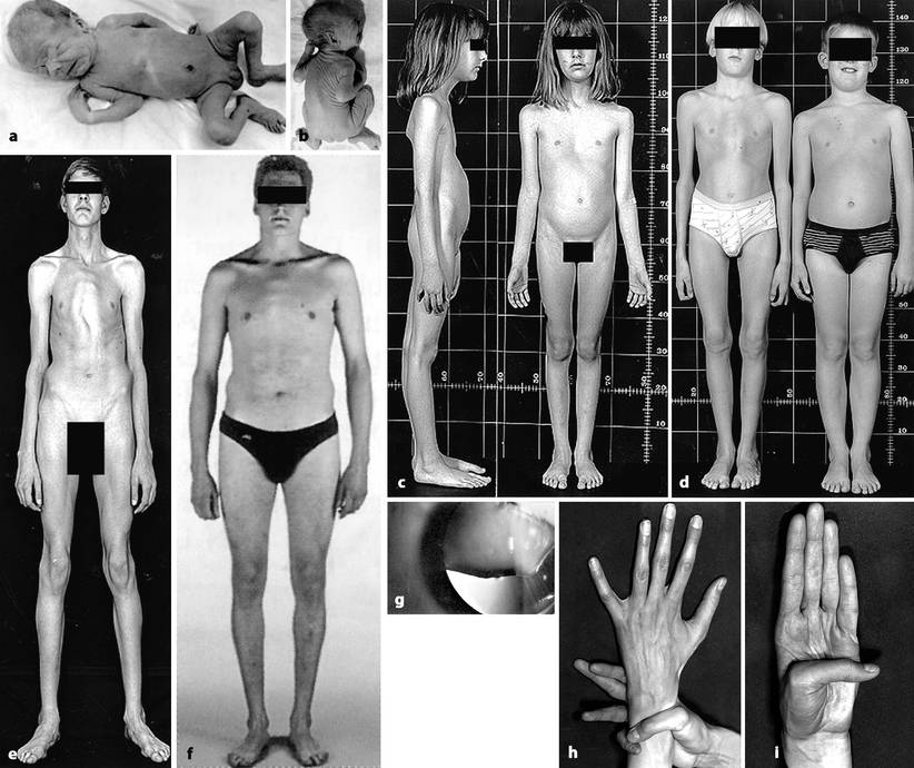 Genetische Bindegewebskrankheiten Springerlink