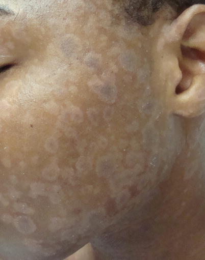 Pityriasis Lichenoides Chronica Springerlink