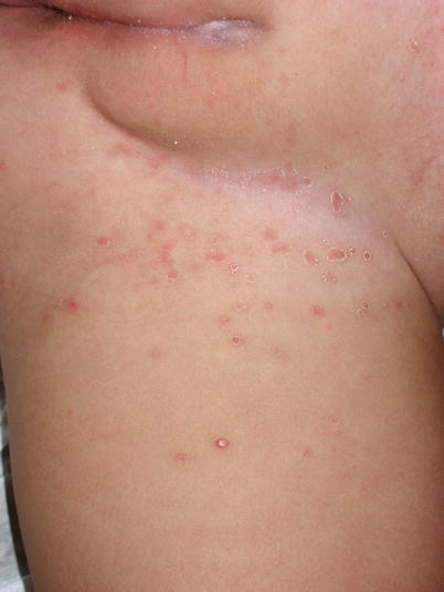 Tinea Corporis Tinea Versicolor And Candidiasis Springerlink
