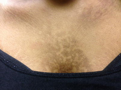 confluent and reticulated papillomatosis vs tinea versicolor)