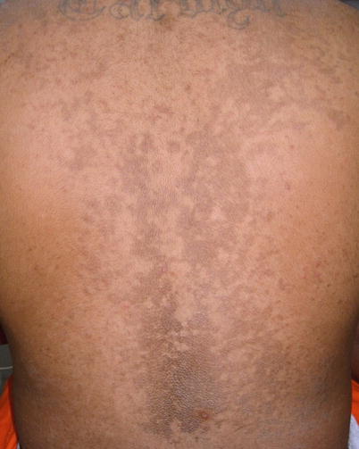 papillomatosis reticularis