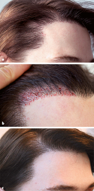 Sonderformen Der Haartransplantation Springerlink