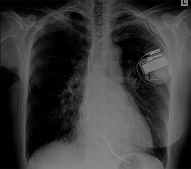 Schrittmacher Und Defibrillatortherapie Springerlink