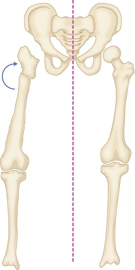 Pelvic Support Osteotomy (PSO): Indications, Limits and Complications ...