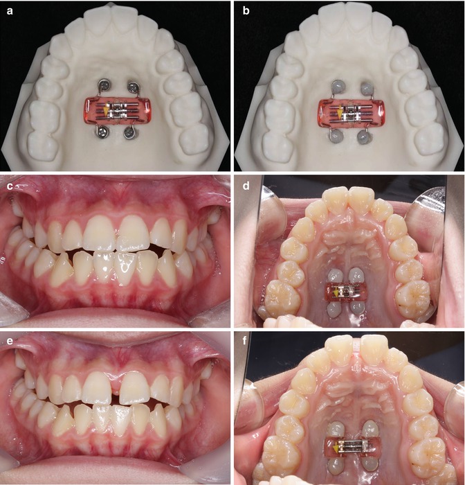 BoneAnchored Rapid Palatal Expansion SpringerLink