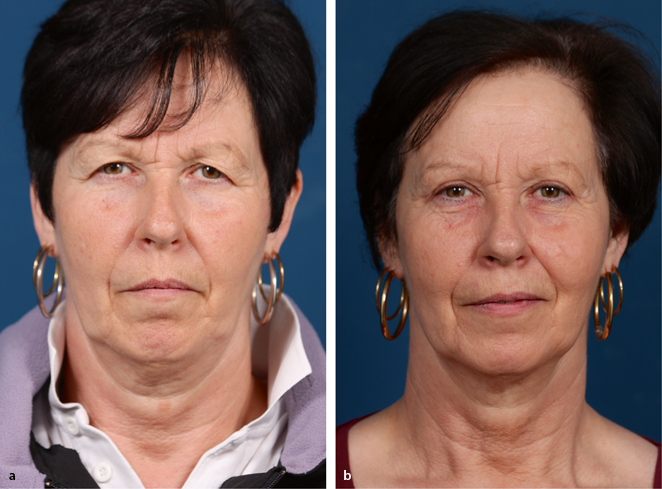 Ober Und Unterlidblepharoplastik Springerlink