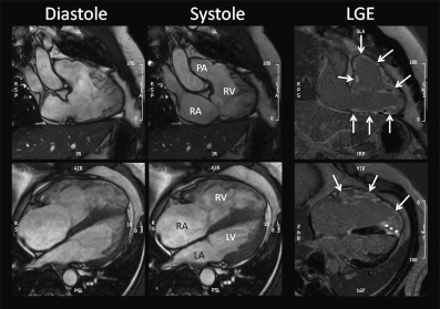 Kardio Mrt In Der Sportkardiologie Springerlink