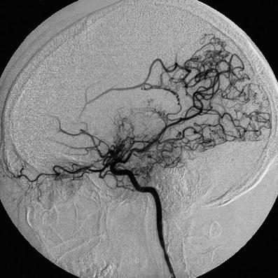 Vaskulopathien Nichtarteriosklerotische Gefasserkrankungen Springerlink