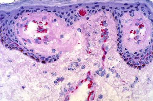 Gefäßtumoren der Haut SpringerLink